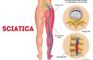 sciatica and most common causes of sciatica